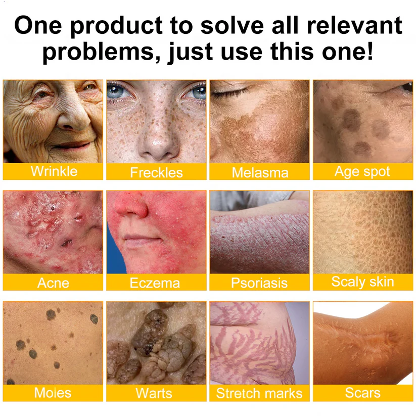 🍟Ourlyard® Bee venom Pro Comprehensive Cream — 🔥Limited Time 80% OFF🔥