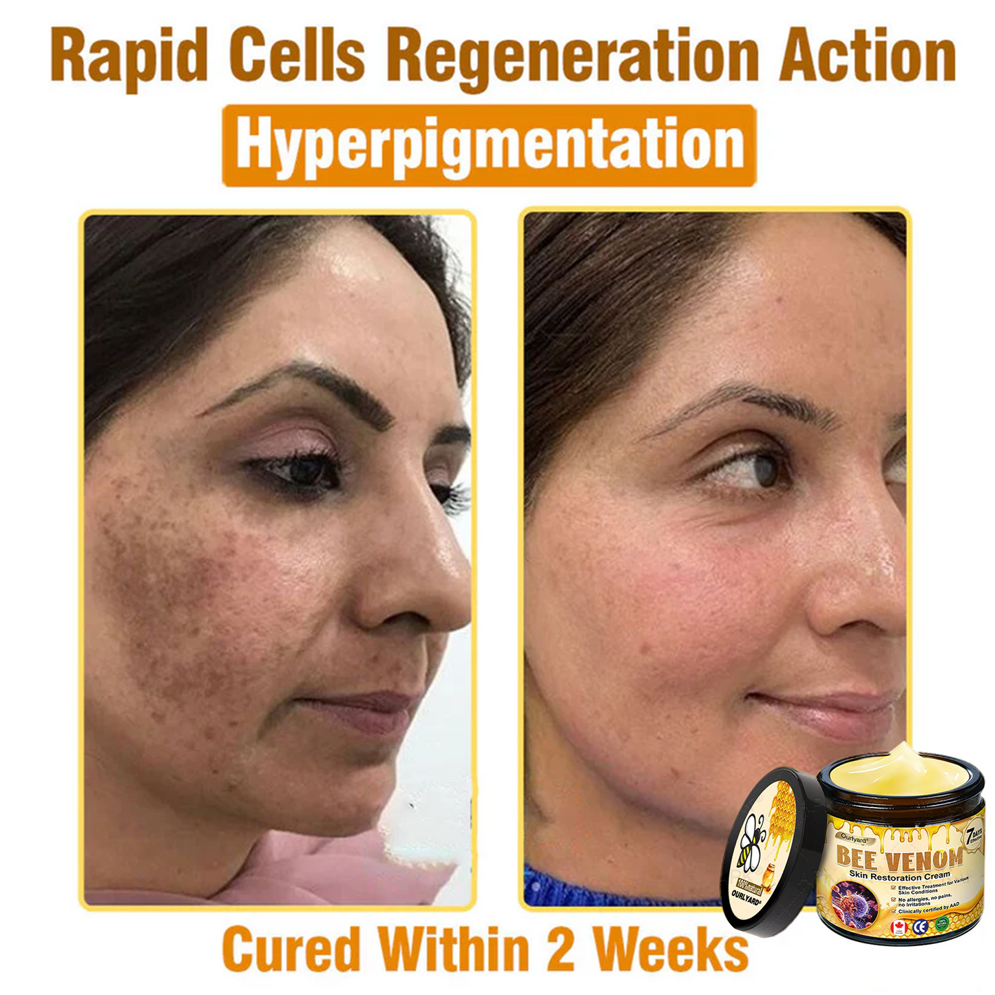 🍟Ourlyard® Bee venom Pro Comprehensive Cream — 🔥Limited Time 80% OFF🔥