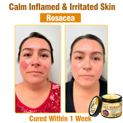 🍟Ourlyard® Bee venom Pro Comprehensive Cream — 🔥Limited Time 80% OFF🔥
