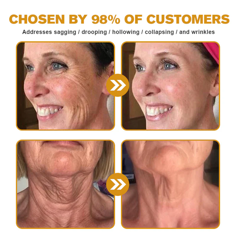🍟Ourlyard® Bee venom Pro Comprehensive Cream — 🔥Limited Time 80% OFF🔥