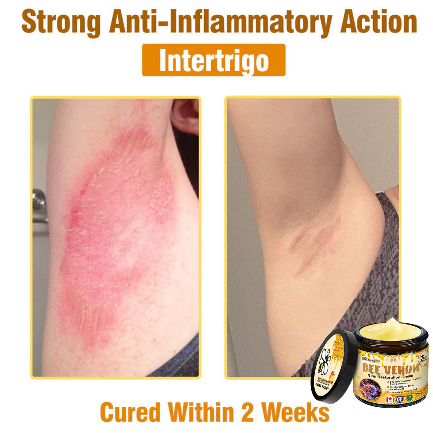 🍟Ourlyard® Bee venom Pro Comprehensive Cream — 🔥Limited Time 80% OFF🔥